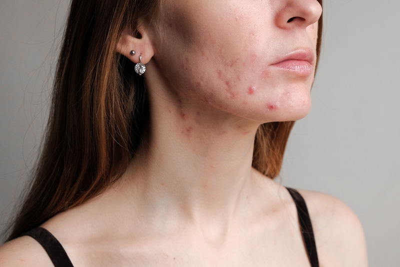 Innovated ACNE Solution